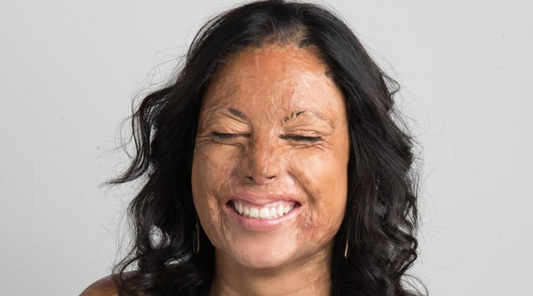 Finding Strength Through Scars: My Journey of Resilience and Positivity